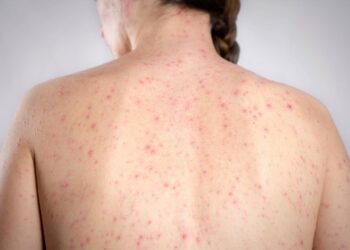 Morbillo, dagli aeroporti Usa alle scuole di Londra: dilagano gli alert