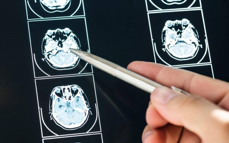 Ecco come il Long Covid cambia il cervello con meccanismi tipici dell’Alzheimer